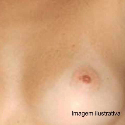 Cirurgia de redução de mama tem maior taxa de complicações em mulheres mais velhas